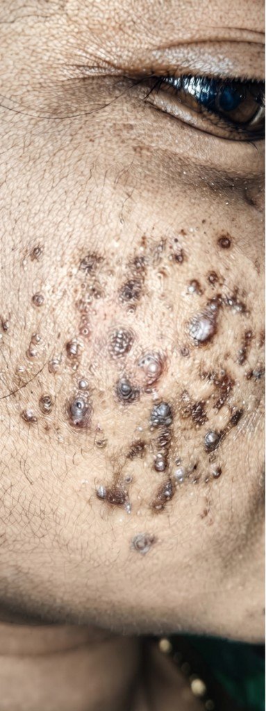 Raised facial lesions before treatment at Prohealth Care Clinic