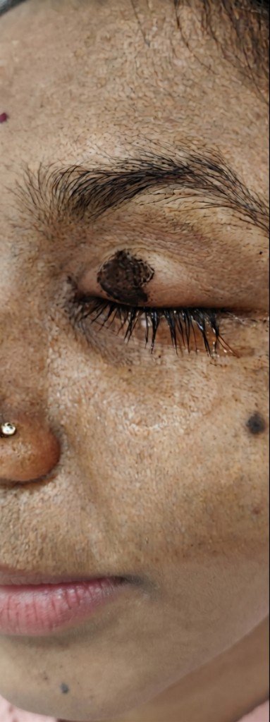 Eyelid lesion before treatment at Prohealth Care Clinic