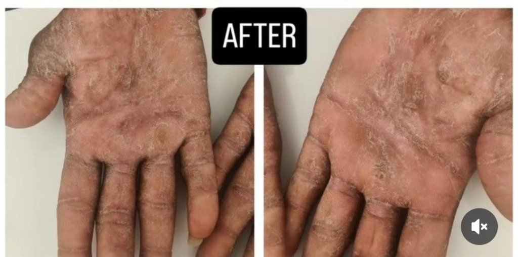 Palms after dermatology treatment at Prohealth Care Clinic