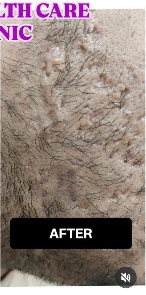 Skin after lesion treatment at Prohealth Care Clinic
