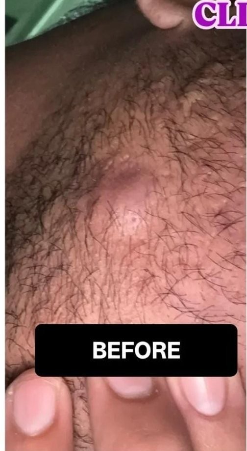 Skin lesion before treatment at Prohealth Care Clinic