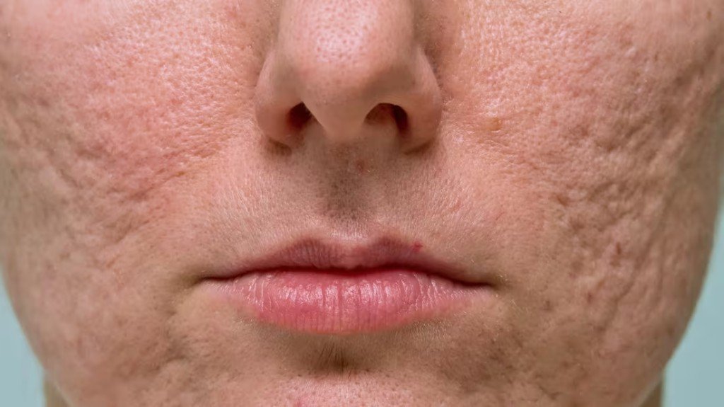 Educational illustration of acne scarring. Not a verified patient photograph.