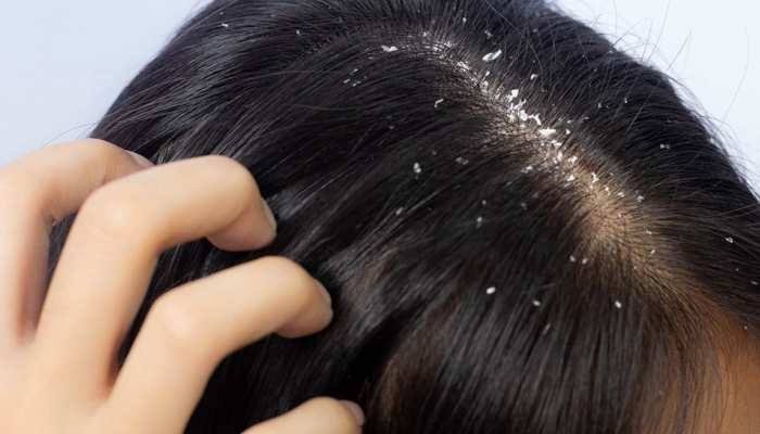 Educational illustration of dandruff and scalp flakes. Not a verified patient photograph.