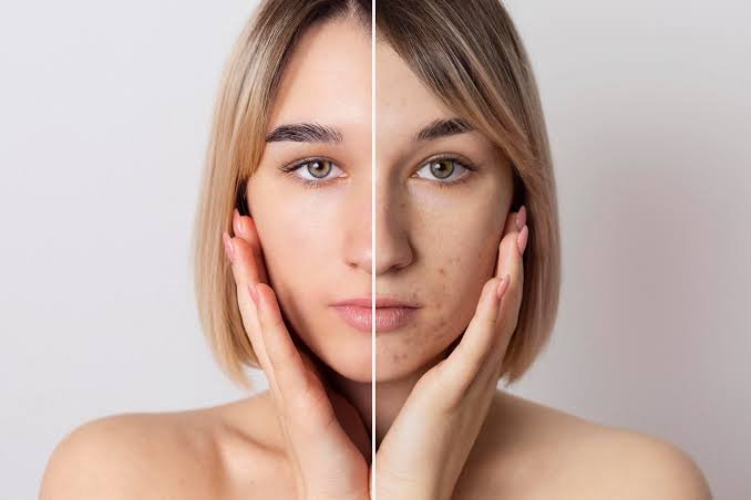 Educational illustration of pigmentation treatment. Not a verified patient photograph.