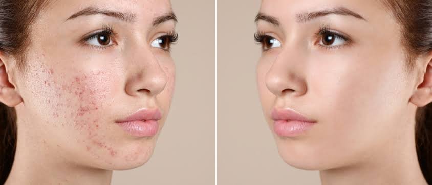 Acne Scars Treatment in Pune