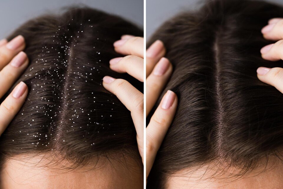 Dandruff Treatment in Pune