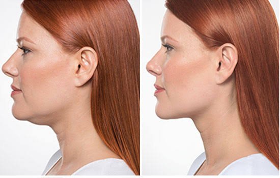 Double Chin Reduction Treatment in Pune