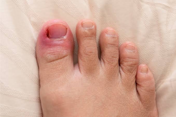 Ingrown Toenail Treatment in Pune