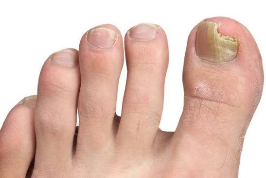 Nail Fungus Treatment in Pune
