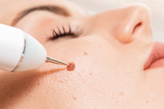 Wart Removal Treatment in Pune